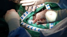 Diseksi Aorta Kompleks